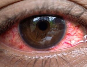 Uganda’da salgın: 7 bin 500 kişide “kırmızı göz” hastalığı görüldü